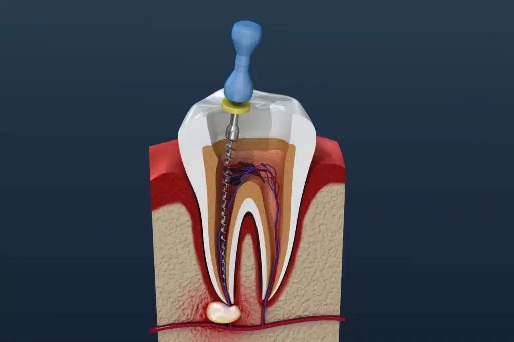 3D-illustration-of-root-canal-brownstown-mi