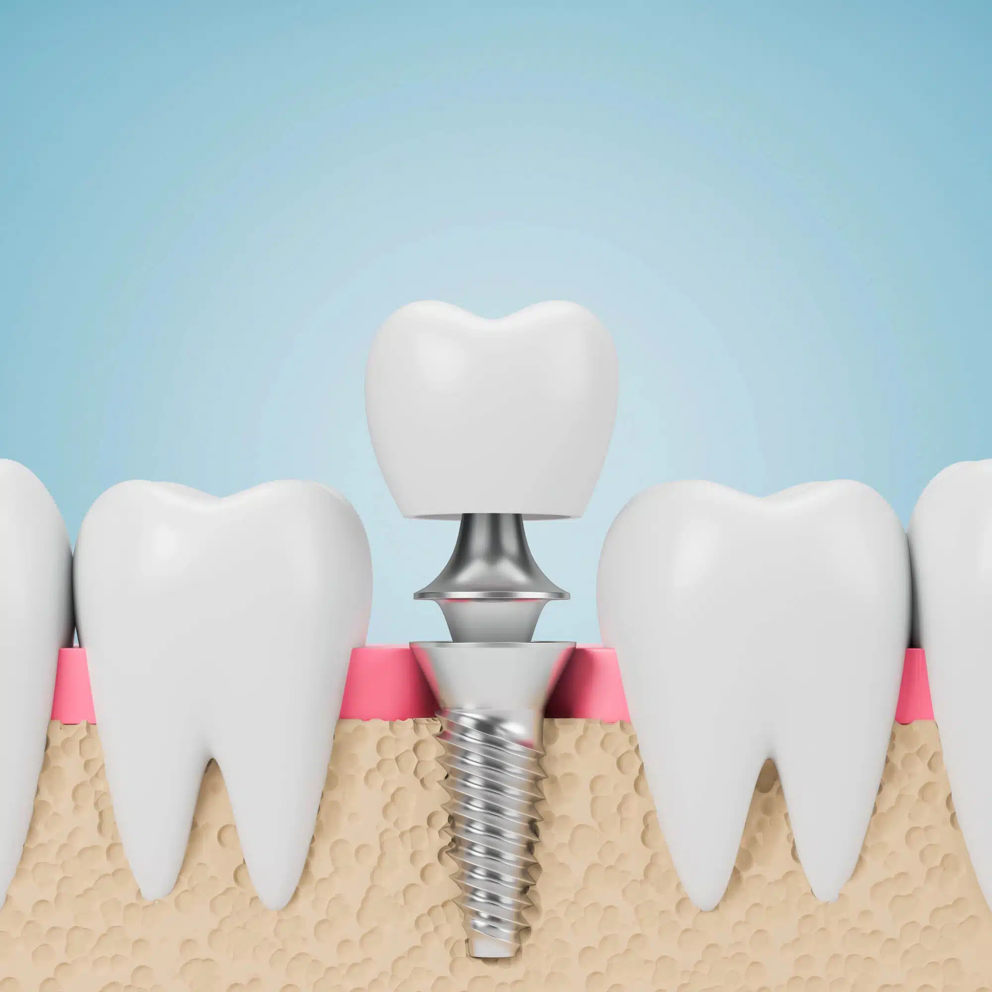 3D illustration of brownstown dental implants