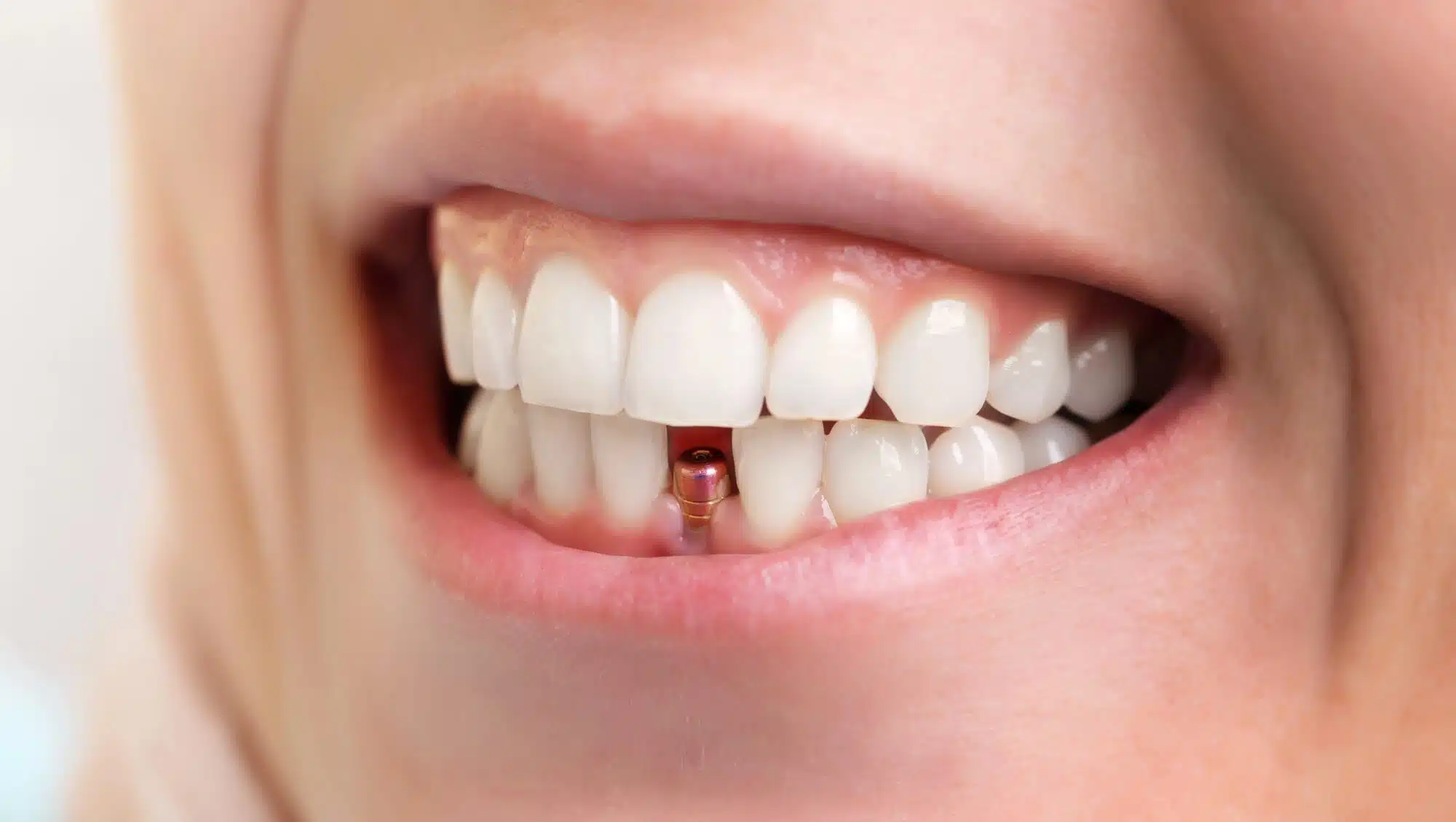 brownstown dental implants